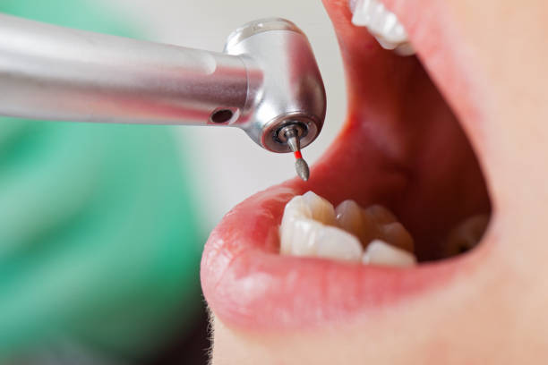 Teeth Whitening in WA